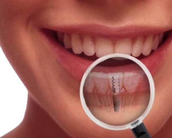 Implants Dentaires